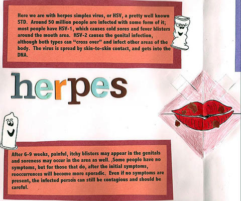 Herpes